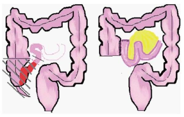Ileocecectomy For Crohn s disease Removes the end of the small