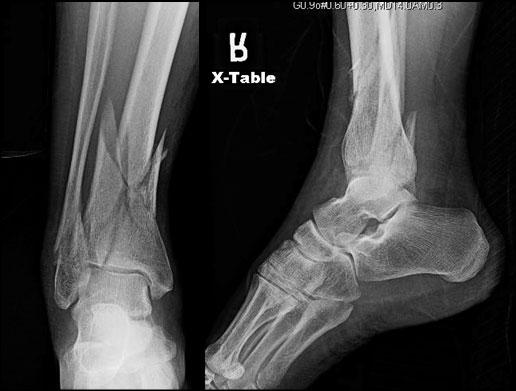 distal 1/3 tibia shaft fracture with IM Rod None with Fibular