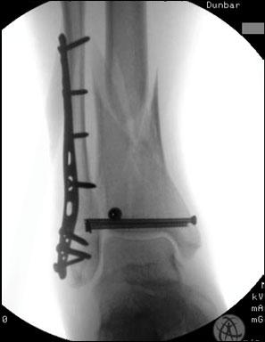 this fracture 1) Consider fixing the Fibula to help with: -Length -