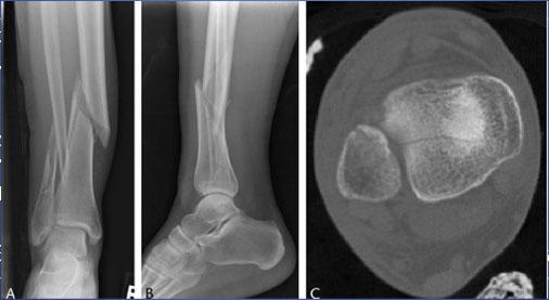 79 patients with IM Rod of ANY tibia shaft fracture X- Rays and CT scan in all