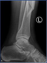 Incidence of Intra-articular fracture: SPIRAL FRACTURE pattern (n=25) = 92% (50% not