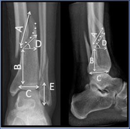 25 pts with Spiral Distal 1/3 tibial fractures AP/lateral X-ray, CT Scan & MRI of ipsilateral ankle By CT - 56% found to have injury to ankle Negative CT = MRI 64% with injury to