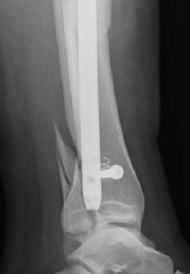 lateral of the ankle a
