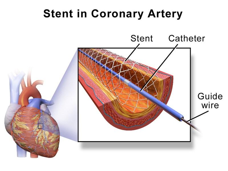 Stent Heart-Lung machine Plastic or metal framed balloon collapsed into a thin catheter and inserted