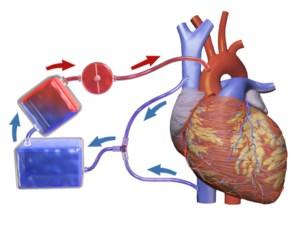 Life saver A pump that takes on the role of the heart and filtrates oxygen into the blood in order