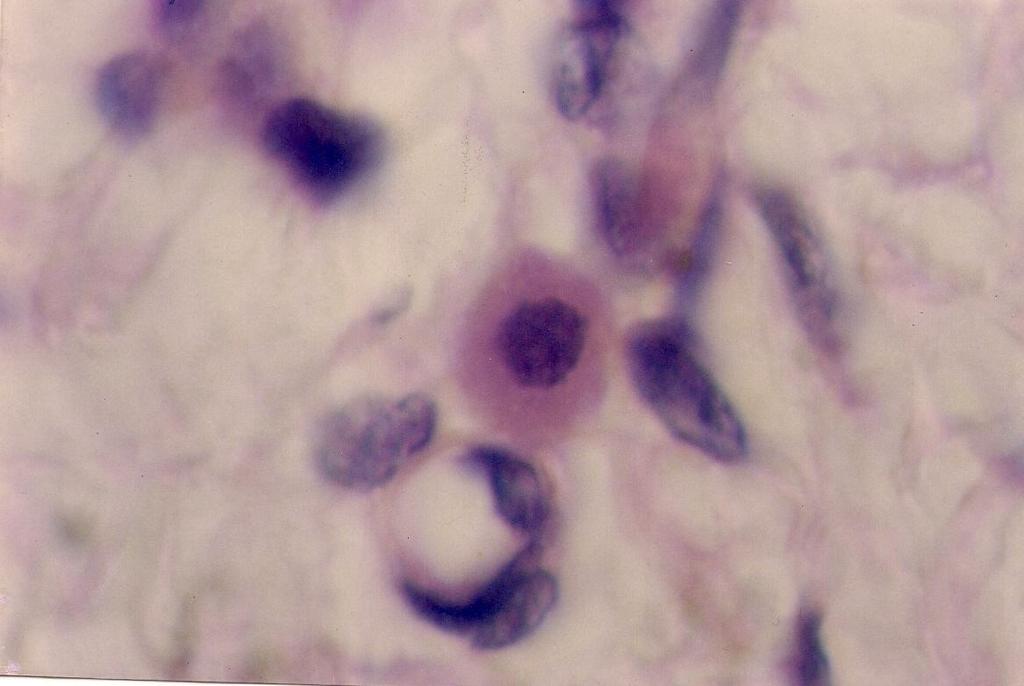 A mast cell with large eosinophilic cytoplasm and centrally placed nucleus seen in close