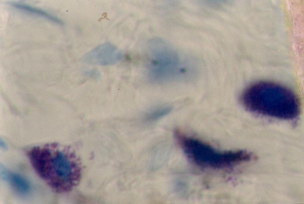 (toluidine Blue,10 x) Degranulated mast cells with pale pink cytoplasm and well defined blue