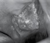 Squamous cell carcinoma may also be preceded by a precancerous lesion, such as leukoplakia.