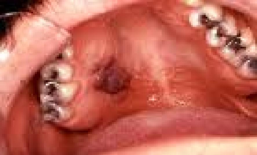 39965 Pardeep Mahajan, Oral manifestations of hiv infection necrosis of one or more interdental papillae, accompanied by pain, bleeding, and fetid halitosis.