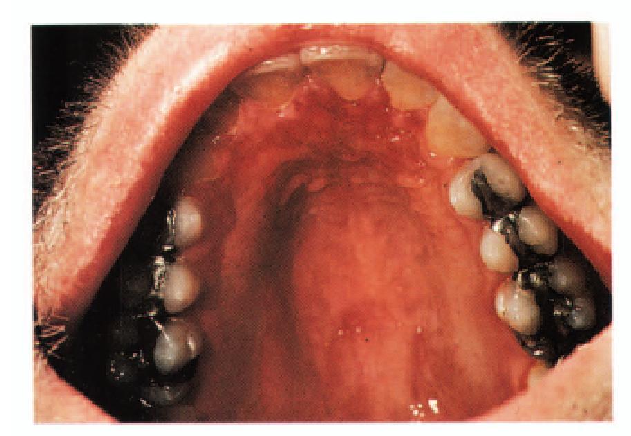 Herpes simplex virus (HSV) infection may be either primary (herpetic gingivostomatitis) or secondary (herpes labialis).
