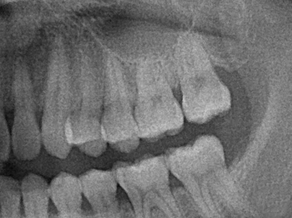 Verruciform xanthoma of the palatal gingiva in size, shape, or position. The patient did not report any significant past medical history, history of trauma, or exceptional medical or family history.