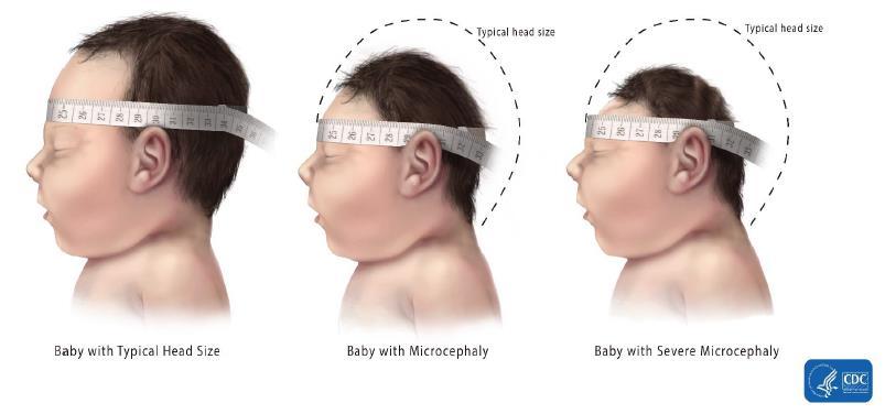May 17, 2017 48 Microcephaly Diagnosis Prenatally: Can be difficult to diagnose May be detected by routine ultrasound at 18-20 weeks However, best identified on ultrasound later in pregnancy (late