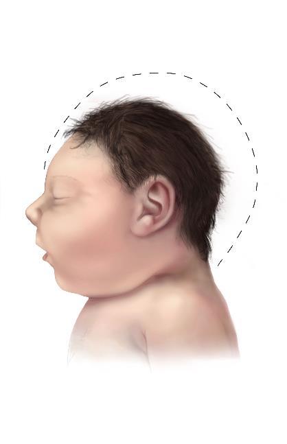 Definitions for possible congenital microcephaly Possible congenital microcephaly for live births If earlier HC is not available, HC less than 3rd percentile for age and sex beyond 6