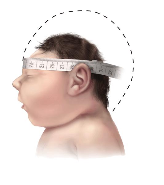 Measuring head circumference for microcephaly Baby with typical head size Baby with Microcephaly Baby with Severe Microcephaly Use a measuring tape that cannot be stretched Securely wrap the tape