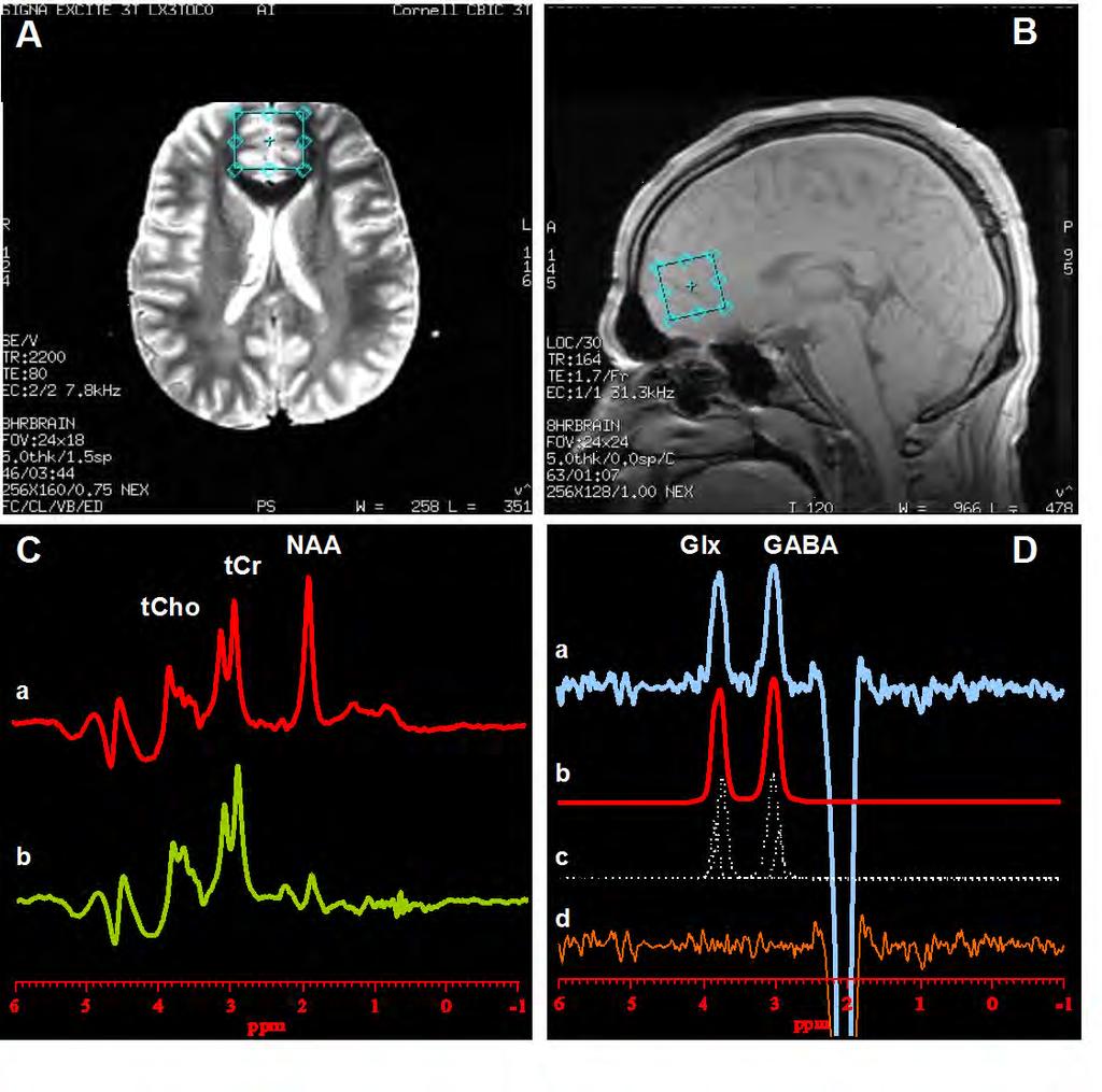Methods [A] axial and [B] sagittal images showing ACC voxel size and location. [C] PRESS 1 H MR spectra with the editing rf pulse [a] off and [b] on.
