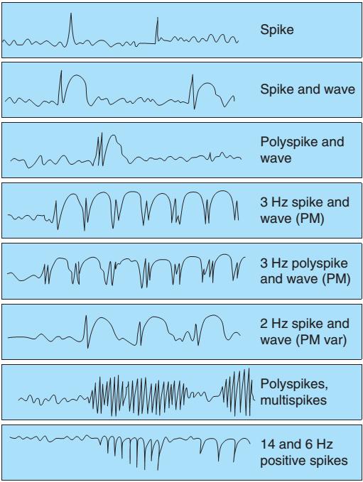 Epileptiform EEG discharges In general, epileptiform wave may be 1.