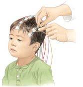 The brain s electrical activity is picked up by electrodes attached on the patient s scalp and