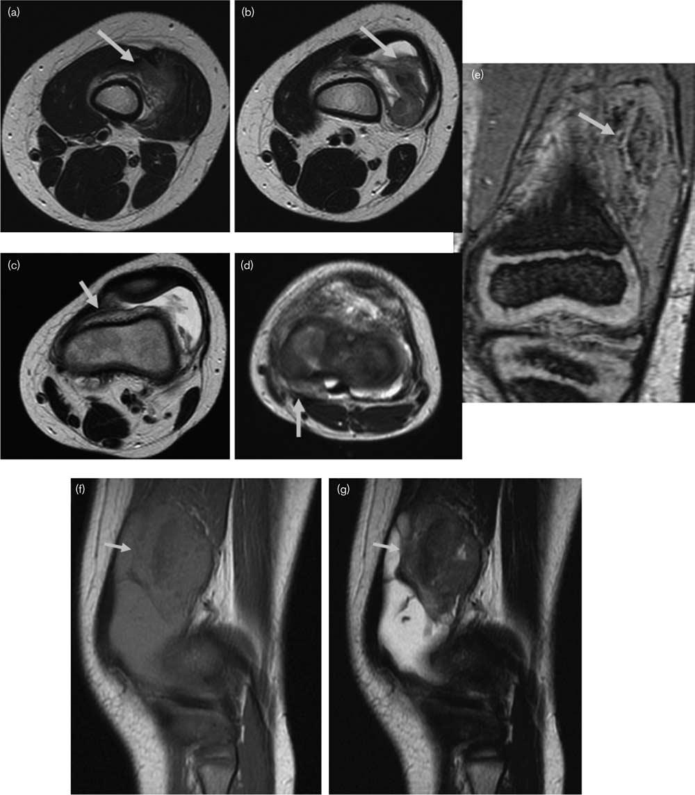 AQ1 Pigmented villonodular synovitis Jha et al. 3 Fig. 3 Preoperative MRI of the left knee.