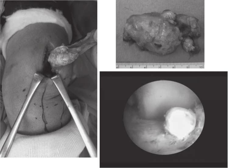 4 Journal of Pediatric Orthopaedics B 2016, Vol 00 No 00 Fig. 4 (a) (b) Prox. Med. Lat. (c) Prox. Med. Lat. Dist. Anterior lesion of the lateral meniscus Dist.