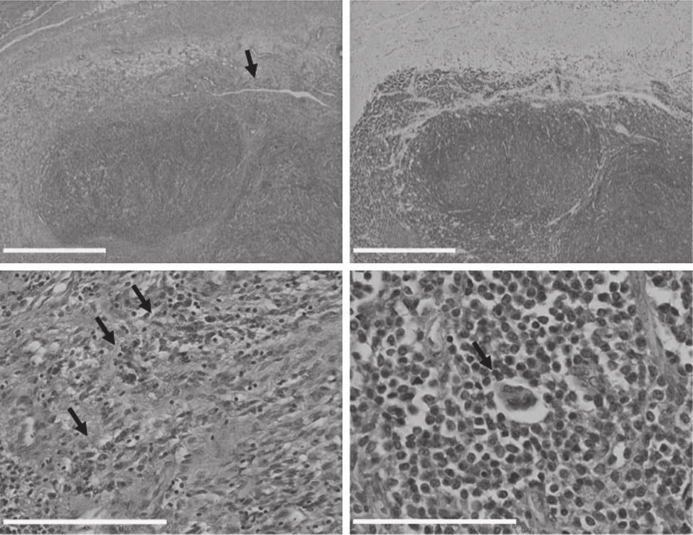 AQ1 Pigmented villonodular synovitis Jha et al. 5 Fig. 5 (a) (b) 1 mm 1 mm (c) (d) 200 µm 100 µm Microscopic images of diffuse pigmented villonodular synovitis.