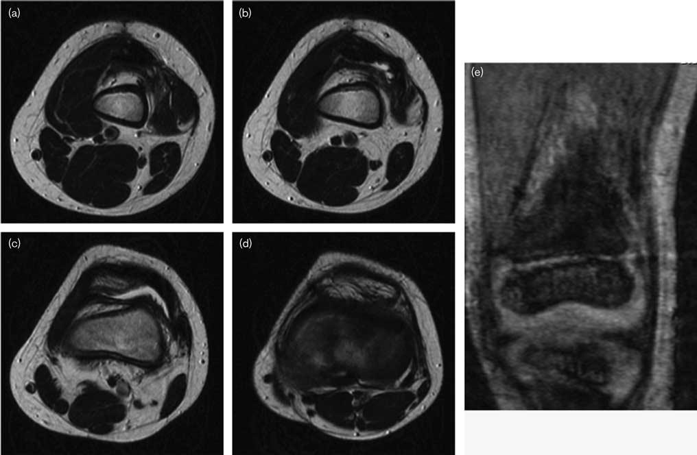6 Journal of Pediatric Orthopaedics B 2016, Vol 00 No 00 Fig. 6 Postoperative MRI of the left knee at 8-month follow-up. (a d) Axial images from the proximal to distal ends.
