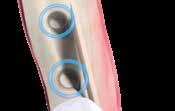 Note lateral distance: The maximum lateral distance is limited by sufficient stabilization of the plate and adequate soft tissue coverage of the augmentation site.