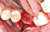 placing the implant too deep. In this case re-augmentation with granules is highly recommended.