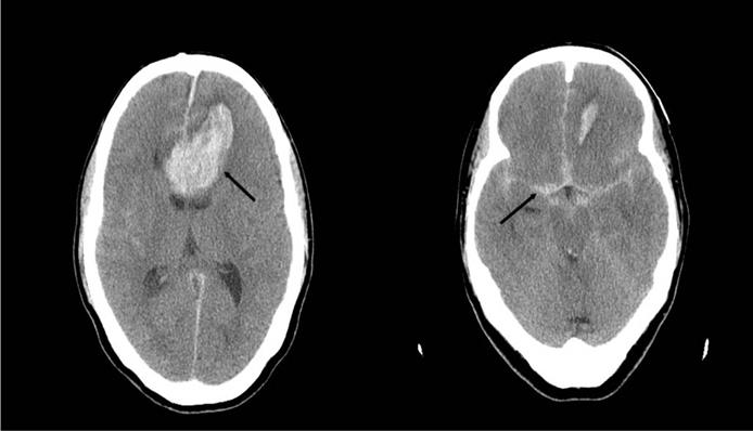 250 Distal Anterior Cerebral Artery Aneurysm Fig 3.