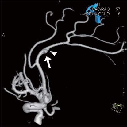 Three-dimensional digital subtraction angiography shows one saccular wide-neck aneurysm (arrow, about 3.6 5.