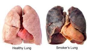 Lung Cancer Lung Cancer Leading cancer killer in North America