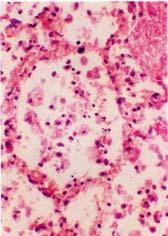 It is characterized by foci of acute suppurative inflammation centered on bronchioles. 1.