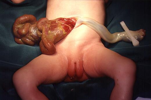 Gastroschisis There is more incidence of intestinal anomalies (atresia) In gastroschisis the gut is extruded through a defect lateral to the umbilicus (Rt).