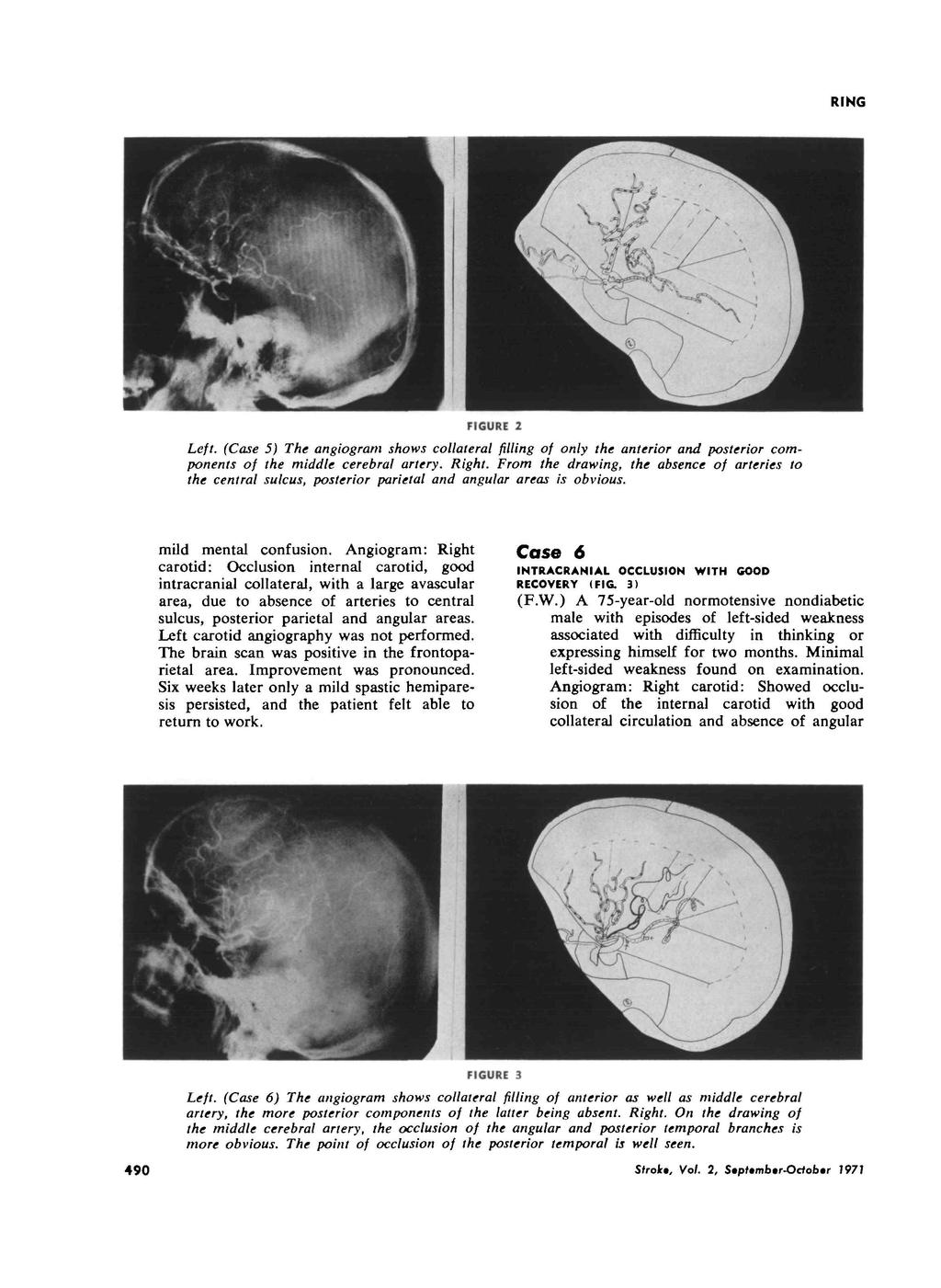 RING FIGURE 2 Left. (Case 5) The angiograni shows collateral filling of only the anterior and posterior components of the middle cerebral artery. Right.