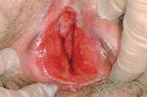Vulvovaginal erosive lichen planus 967 Figure 1. Patient with erosive lichen planus in the vulva. vagina (1,6).