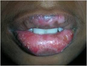 Figure 1: Erosive lesions seen on entire lower lip along with epithelial