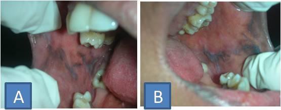 Right buccal mucosa shows healing lichen planus with post inflammatory