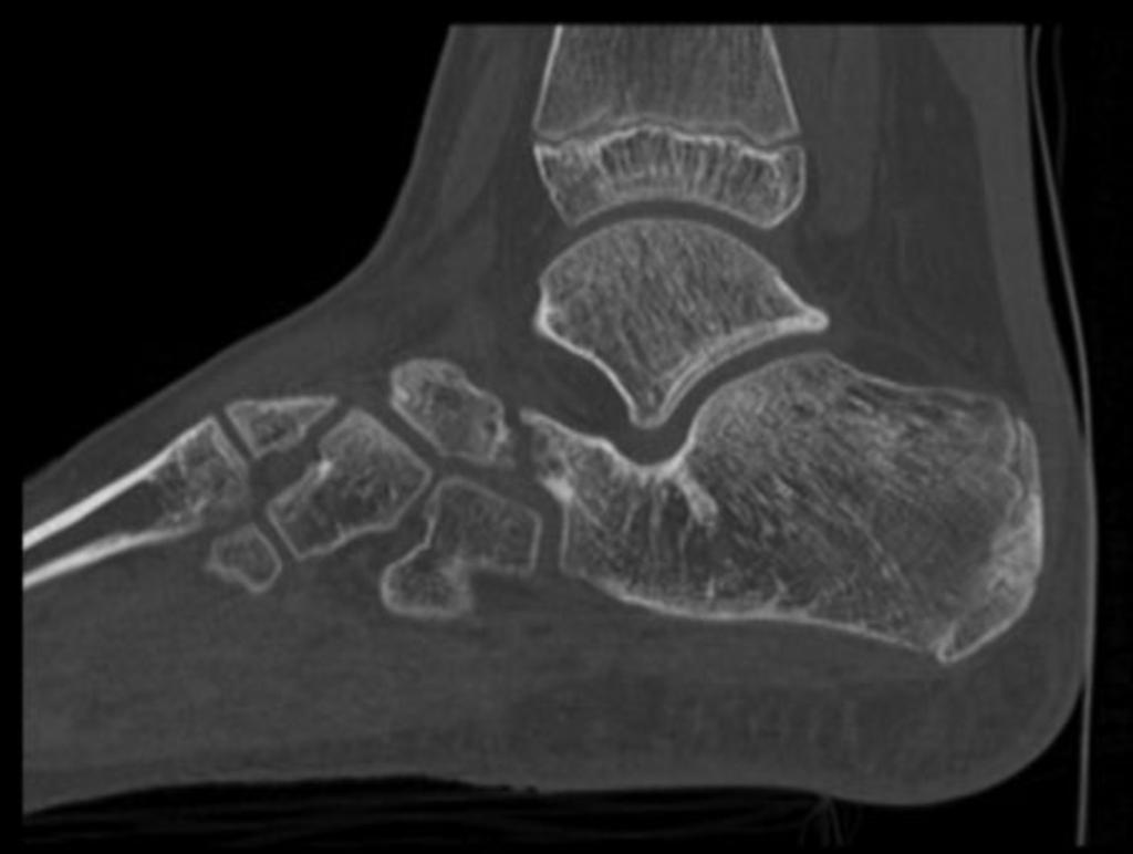 Fig.: 8. CT Saggital reformat showing the narrowed joint space between the calcaneum and navicular with cortical irregularity.
