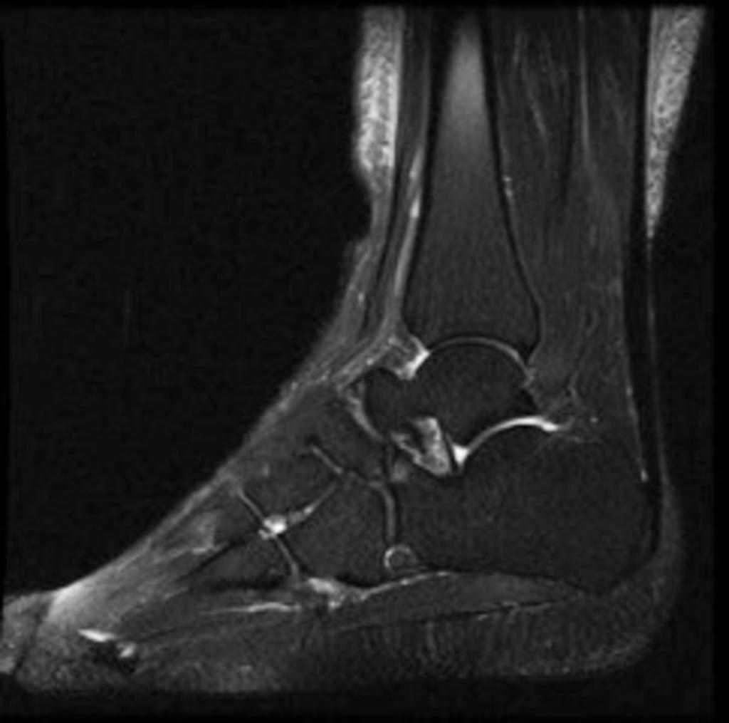 Fig.: 11. Saggital STIR image of a calcaneonavicular coalition with cartilige crossing it.