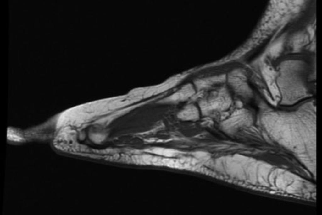 Fig.: 12. Saggital T1 weighted image showing a calcaneonavicular coallition.