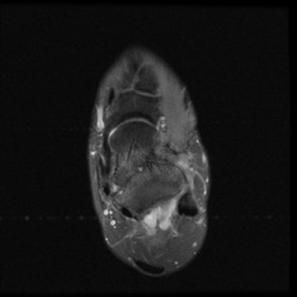 Fig.: 34. Axial proton density fat saturation image. This shows the coalition of the same patient from a different view.