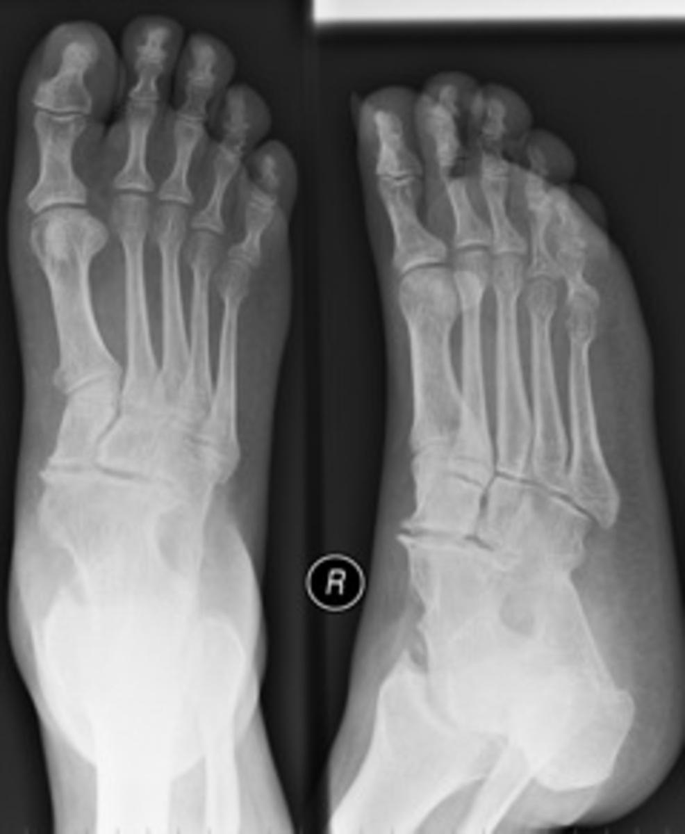 Fig.: 35. Plain radiographs showing multiple hindfoot coalitions between the talus, calcaneum, navicular and cuboid bones.