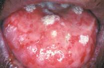 weeks Erythema multiforme minor Prodromal symptoms 1 week prior Fever, malaise,