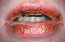 crusting of the lips bloody crusty lips Erythema multiforme minor Self limiting