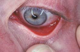 Erythema multiforme major 2 or more mucosal sites are affected with widespread skin lesions Skin + 1. Oral 2. Ocular 3.