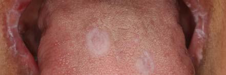 white lines, papules