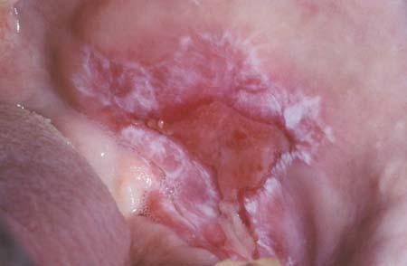 Erosive lichen planus Symptomatic painful Sites: same as