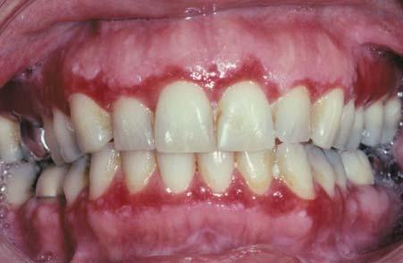 Mucous membrane (cicatricial) pemphigoid Pemphigus vulgaris