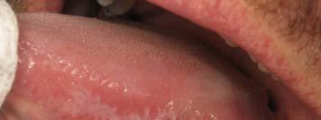 Lichenoid reaction to dental