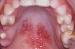 Chi AC et al. Oral Manifestations of Systemic Disease. Am Fam Physician.