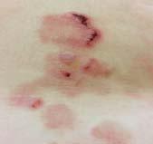 or vesicles: rupture quickly to form ragged erosions and